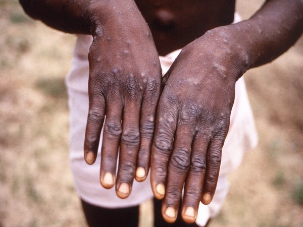 WHO gives new names to variants of monkeypox virus