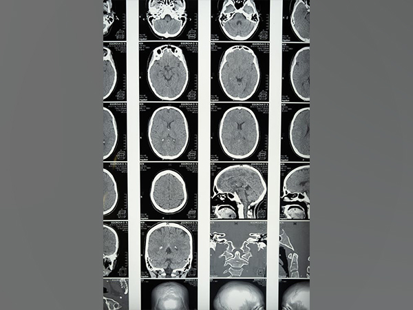 Study: Cells that results in neuronal death