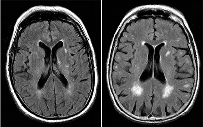 T cells in brain slow progression of Alzheimer’s disease