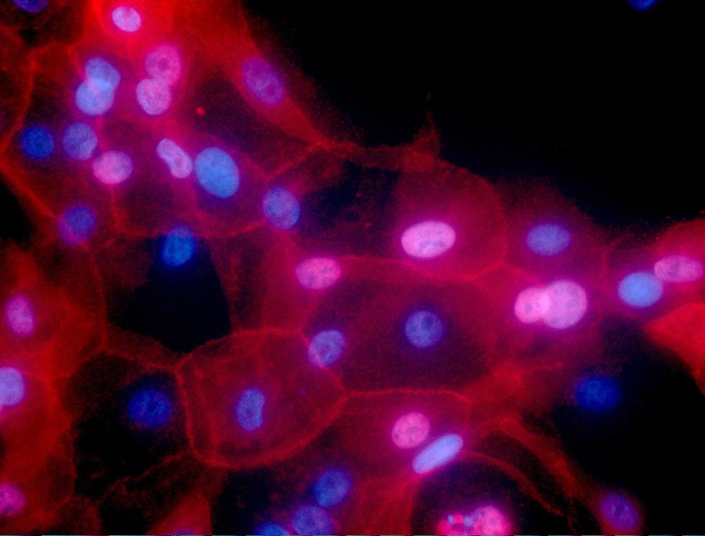 Some cancer patients can skip treatments, 2 studies show