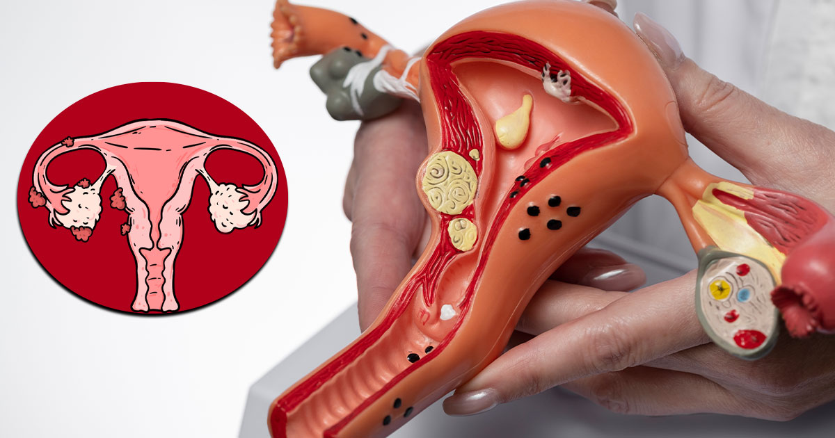 Back Pain Could Be More Than Just Discomfort: Recognizing Endometriosis Symptoms