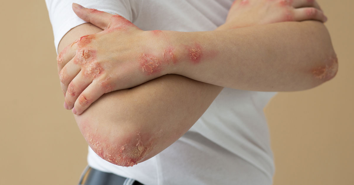 What You Need to Know About Allergies