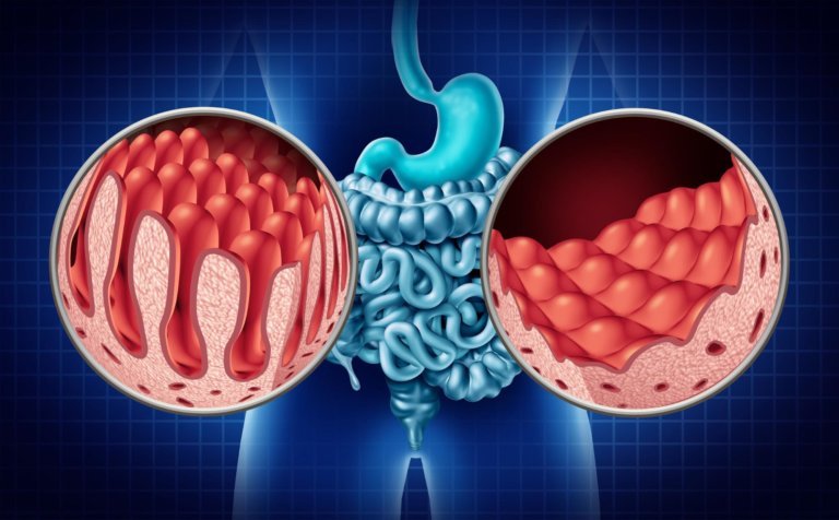 Celiac disease: Understanding the impact on digestive and immune system