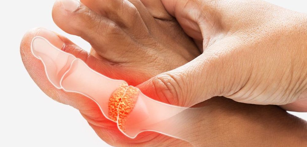 Gout: The painful truth behind a common condition