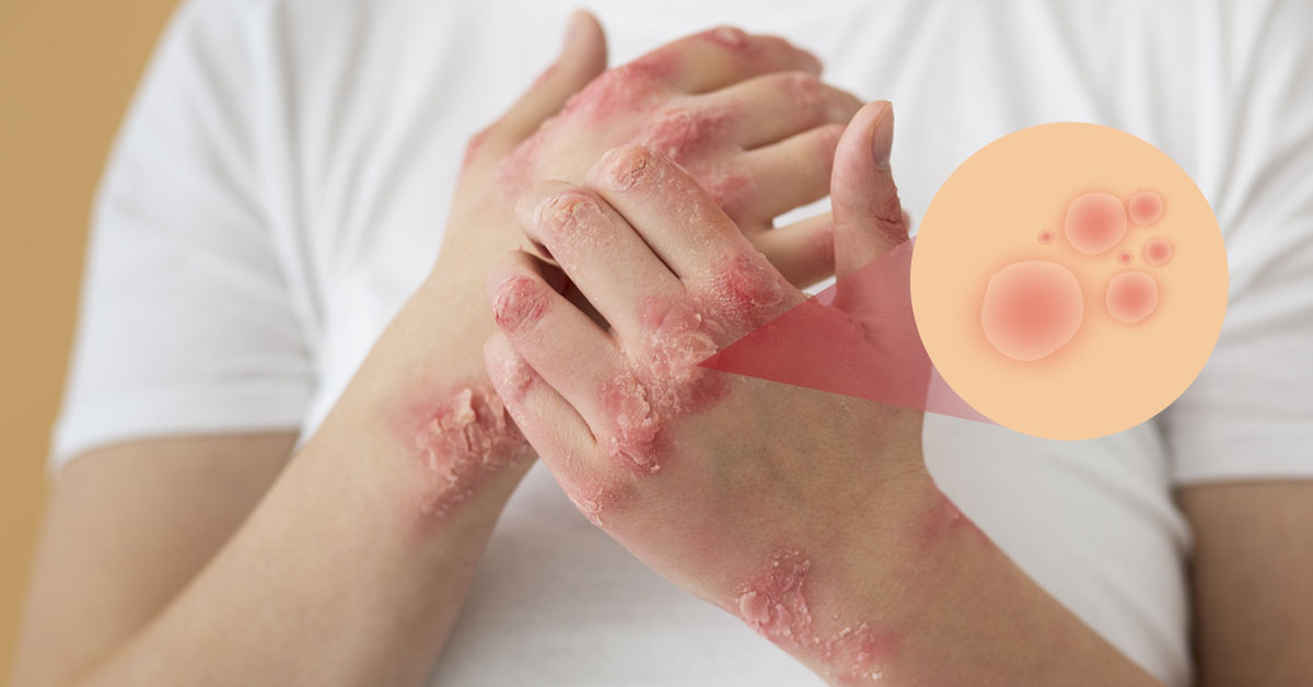 Psoriasis Explained: Managing the Skin Condition and Reducing Flare-Ups