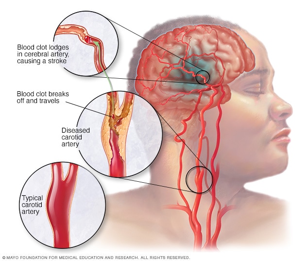 Spotting the Signs of Stroke: Early Detection Saves Lives