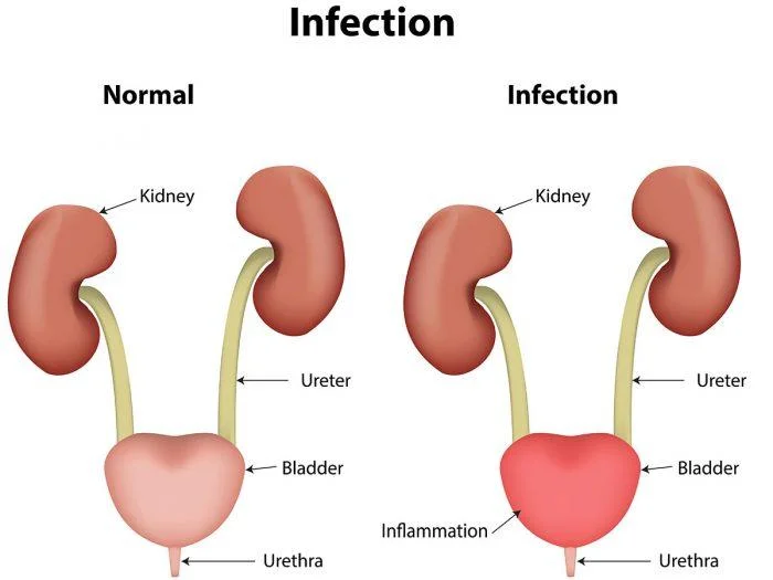 Simple UTI can turn into serious kidney damage