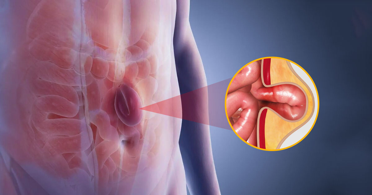 Hernia: Types, Causes, Risk Factors, Symptoms, Diagnosis and Treatment
