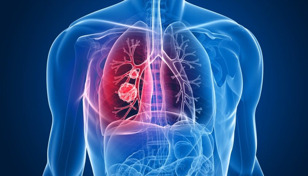 Air pollution fuels lung cancer among non-smokers