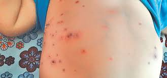 One dies of scrub typhus in Chitwan