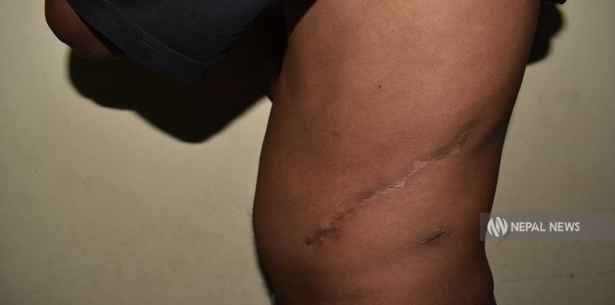 Victims lured by job offers, ended up losing kidneys in India