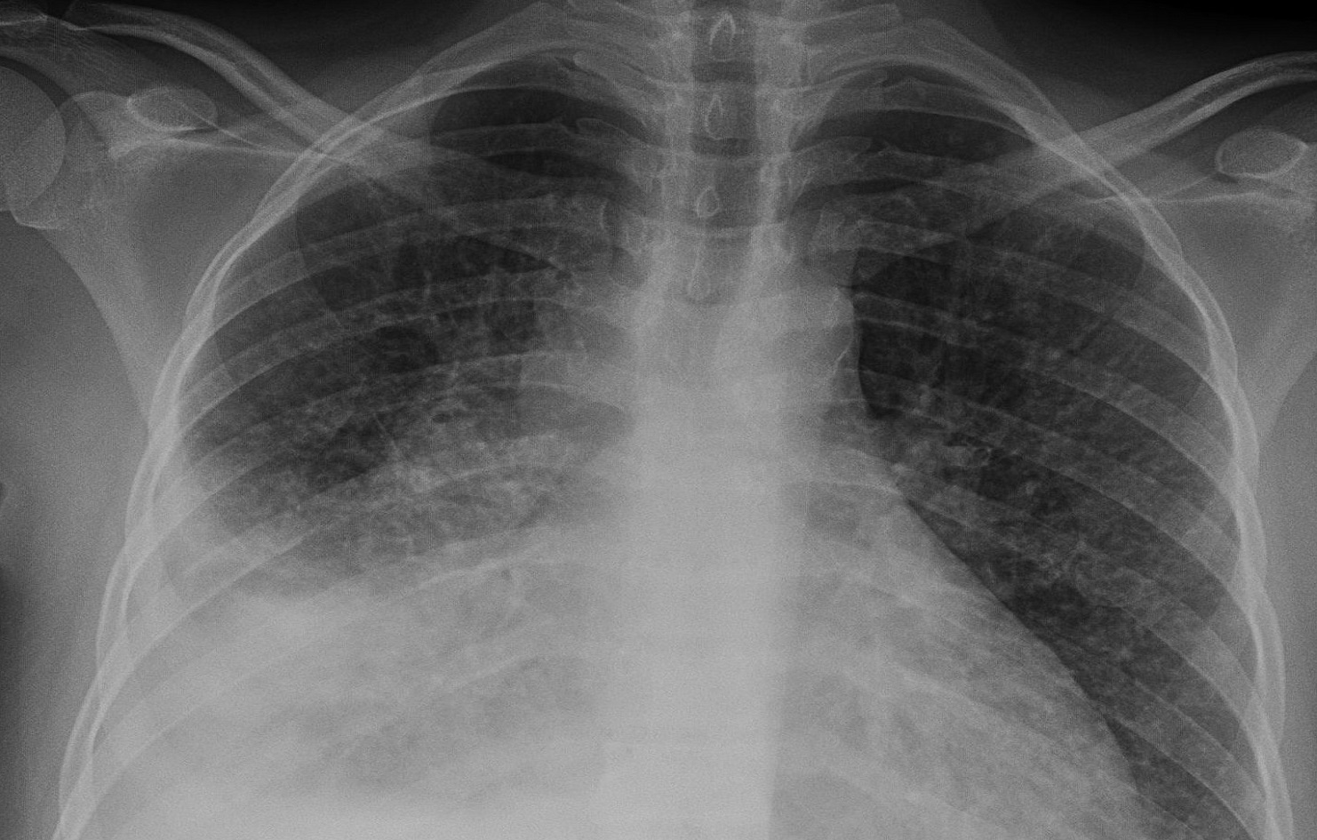 One hundred individuals diagnosed with tuberculosis in Okhaldhunga