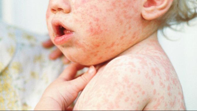 U.S. reports over 2,000 measles cases in 2025, highest since 1992
