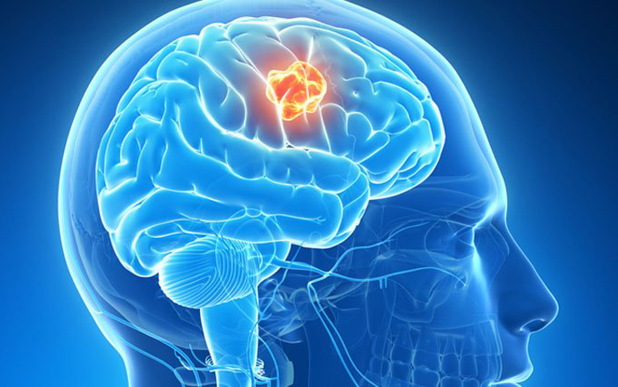 World Brain Tumor Day: Increasing number of patients in Nepal